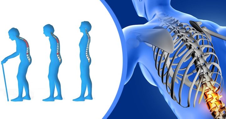 Osteoporosis