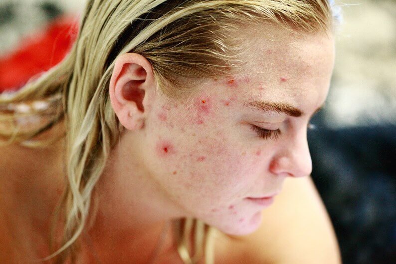 manchas de acné